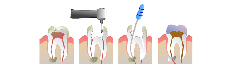 image of endodontic therapy - description below