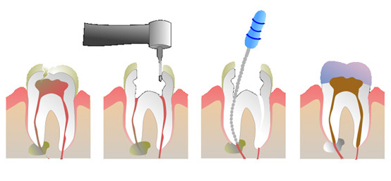 image of endodontic therapy - description below